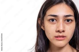 asian woman gets freckles blemish