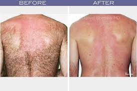 We did not find results for: Laser Hair Removal Is A Permanent Solution To Be Hair Free