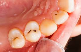 what is rotten teeth symptoms and