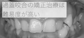 難しい】過蓋咬合の矯正歯科治療 | 千葉県八千代市の矯正歯科専門医院 ...