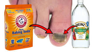 how to get rid of toenail fungus with