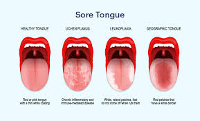 sore tongue symptoms causes
