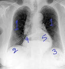 In fact every radiologist and pulmonary physician should be an expert in chest film reading. Deep Learning In Healthcare X Ray Imaging Part 2 Understanding X Ray Images By Arjun Sarkar Towards Data Science