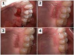gum grafts bone grafts and sinus elevation