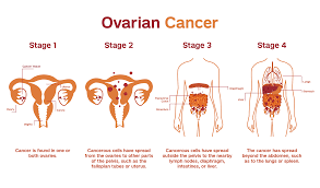 Her belly won't have that classic blubbery look of overweight. Ovarian Cancer Patient Care