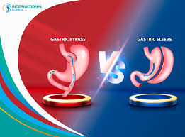 gastric sleeve vs gastric byp