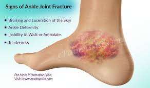 Its function is to stop bleeding and seal the injured tissues. Ankle Joint Fracture Types Classification Symptoms Treatment Recovery