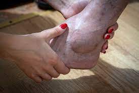 purple black and blue feet in elderly