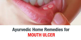 ayurvedic home remes for mouth ulcer