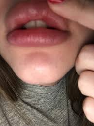 lips 5 months after lip fillers