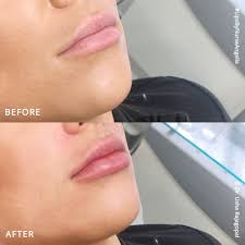 lip augmentation before and after