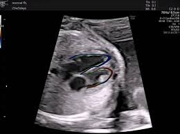 Cardiac Ultrasound Software Streamlines Fetal Heart Exams Daic