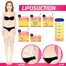 liposuction cost in new york
