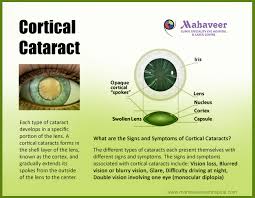 Cortical Cataract Signs And Symptoms Of Cortical Cataract