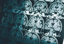 single brain scan can diagnose