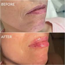 lip filler swelling ses a week by