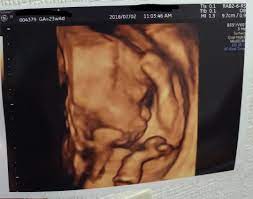 妊娠23週（3-6日）のエコー写真＆体験談