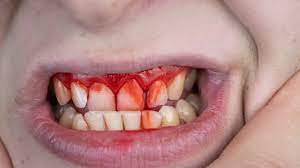 cuts in mouth quick healing tips for