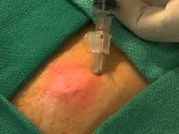 abscess incision and drainage you