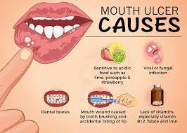 mouth ulcers sabka dentist top