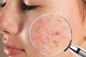 treatment for pimples scars ojas