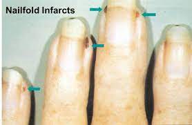 nail fold infarcts capillaroscopy