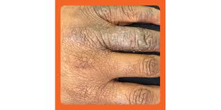 what eczema on black skin looks like
