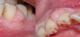Gusi bengkak merupakan salah satu gangguan gigi yang menyebabkan rasa yang tidak nyaman. Gusi Bernanah Punca Simptom Dan Rawatan The Diagnosa