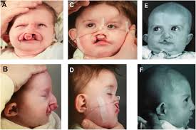 cleft lip and palate in charge syndrome