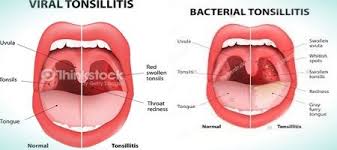 Difference Between Viral And Bacterial Tonsillitis Types
