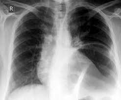 Pain below the ribs can feel dull or sharp. Chest X Ray Showing An Elevated Air Fluid Left In The Left Basal Lung Download Scientific Diagram