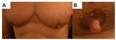 Dermatopathology | Free Full-Text | Bilateral Nipple Enlargement as a  Secondary Effect of Anabolic Drugs: A Histopathological Mimicker of Smooth  Muscle Hamartoma