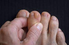 Blisters on Toes: Causes and Treatments