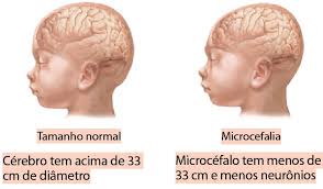 Resultado de imagem para fotos sobre casos de microcefalia no rn.