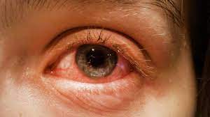 conjunctivitis pink eye symptoms