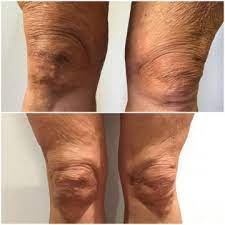 new treatment for crepy skin dr