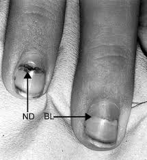nail dystrophy a clinical sign of