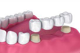 dental bridges fixed partial dentures