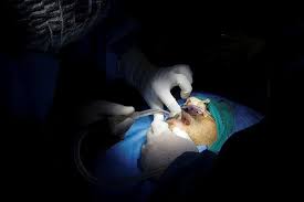 Algunos pacientes solo han podido ser salvados al extirparles un ojo. Siguen Apareciendo Casos De Pacientes Con Hongo Negro En Chile Deberiamos Preocuparnos La Tercera