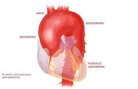 aortic aneurysm and dissection ile ilgili görsel sonucu