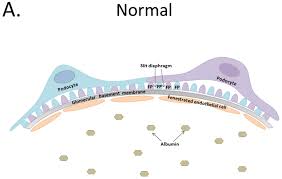 Diabetic Kidney Disease