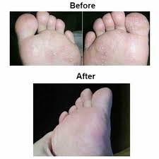 foot odor eliminating pad eczema