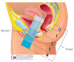 understanding treating pelvic organ