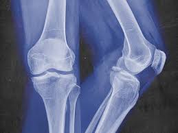 bone fracture repair procedures risks