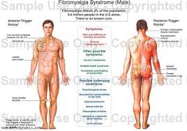 Fibromyalgia Tender Point Chart For Men Crystia214 Get