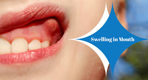 swelling in your mouth