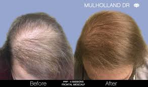 non surgical hair restoration in
