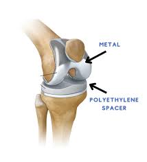 nerve pain after knee replacement