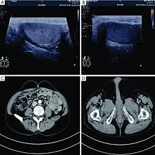 ultrasound and ct images of the lipomas