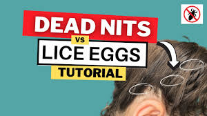 dead nits vs live lice eggs video